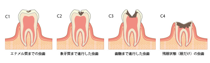 虫歯治療画像