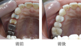 ハイブリッドセラミックを使用した審美性の高い治療