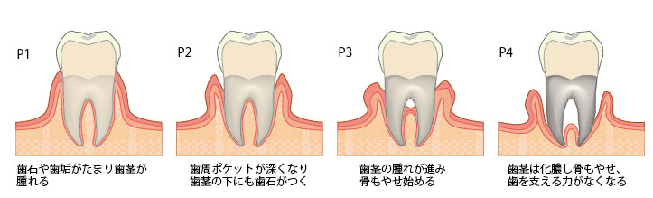 歯周病画像