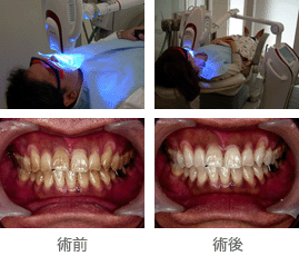 ホワイトニング治療画像